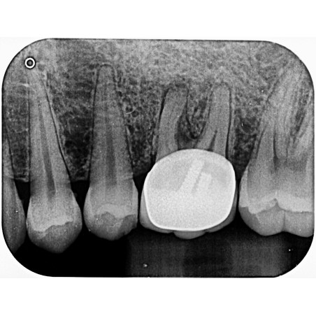 Paquete Rayos X Dental Portátil Ray98 Runyes + Radiovisiógrafo Woodpecker i-Sensor