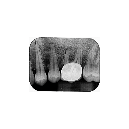 Paquete Rayos X Dental Portátil Ray98 Runyes + Radiovisiógrafo Woodpecker i-Sensor