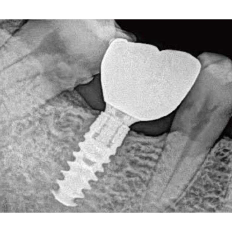 Paquete Rayos X Dental Portátil RXS + Radiovisiógrafo EcoSensor